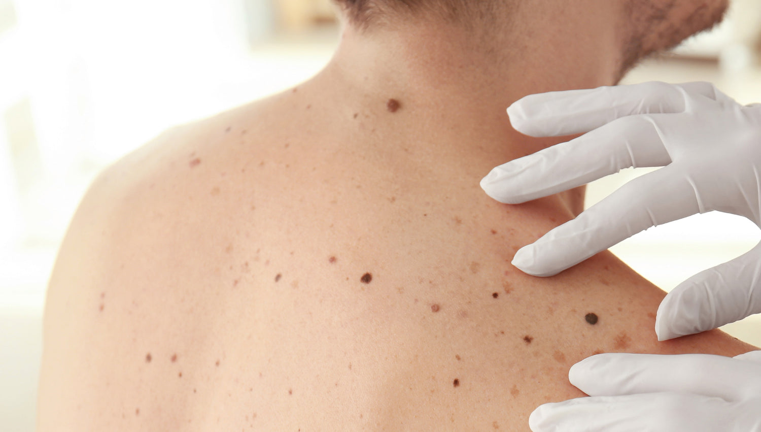 Mole Check 101: The 5 Signs You Should Never Overlook