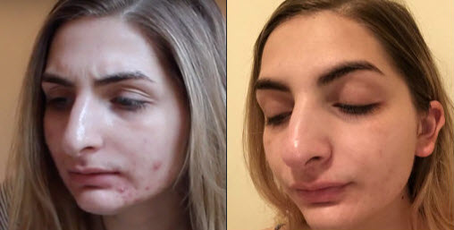 Francesca Before and After Lexli